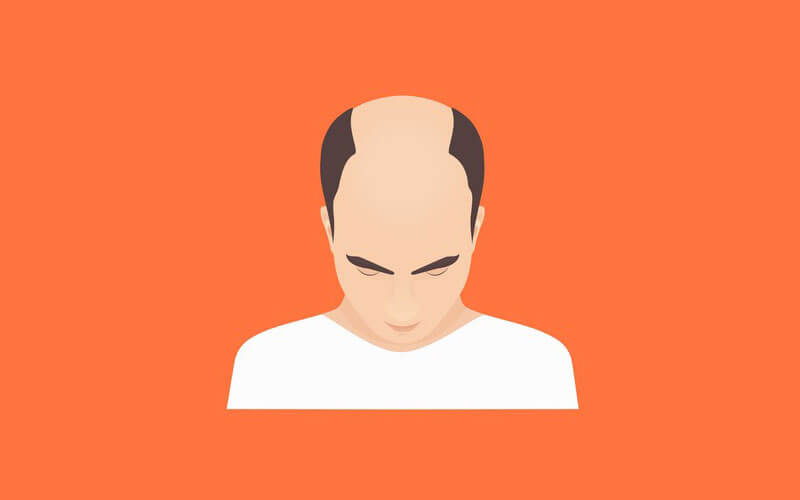 male hair loss