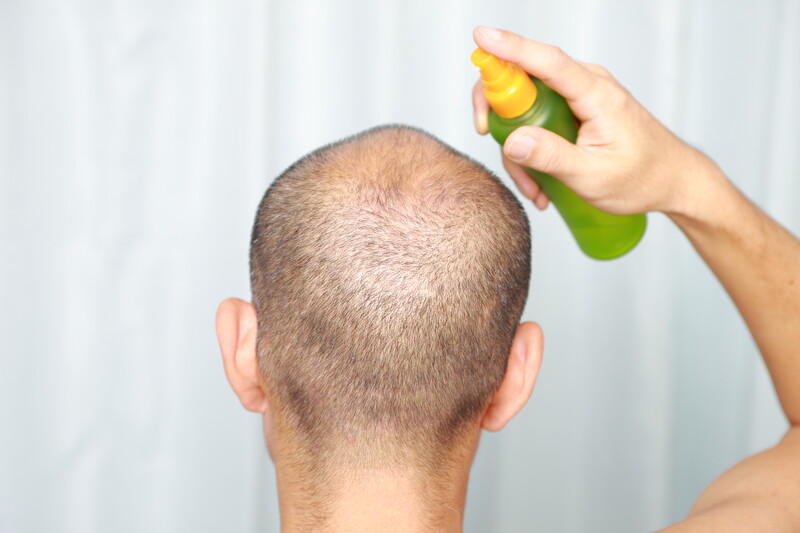 men hair loss solutions
