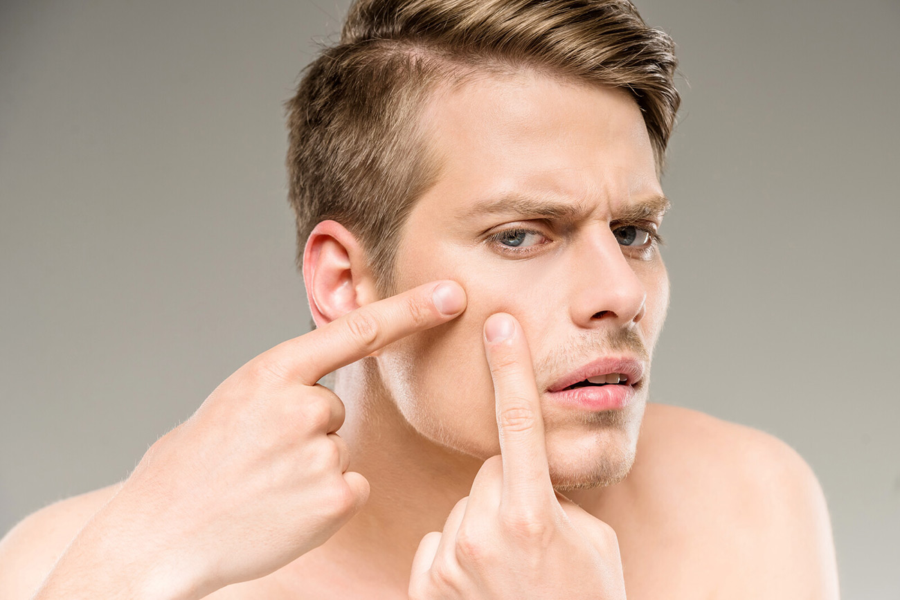 How to Treat Acne for Men