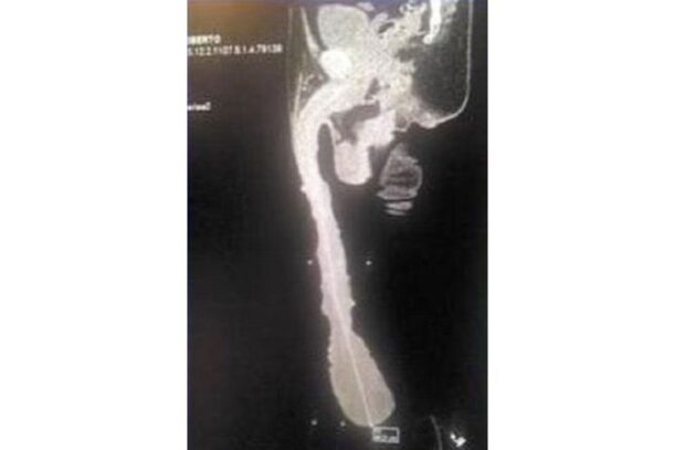 radiographie du plus gros pénis au modne