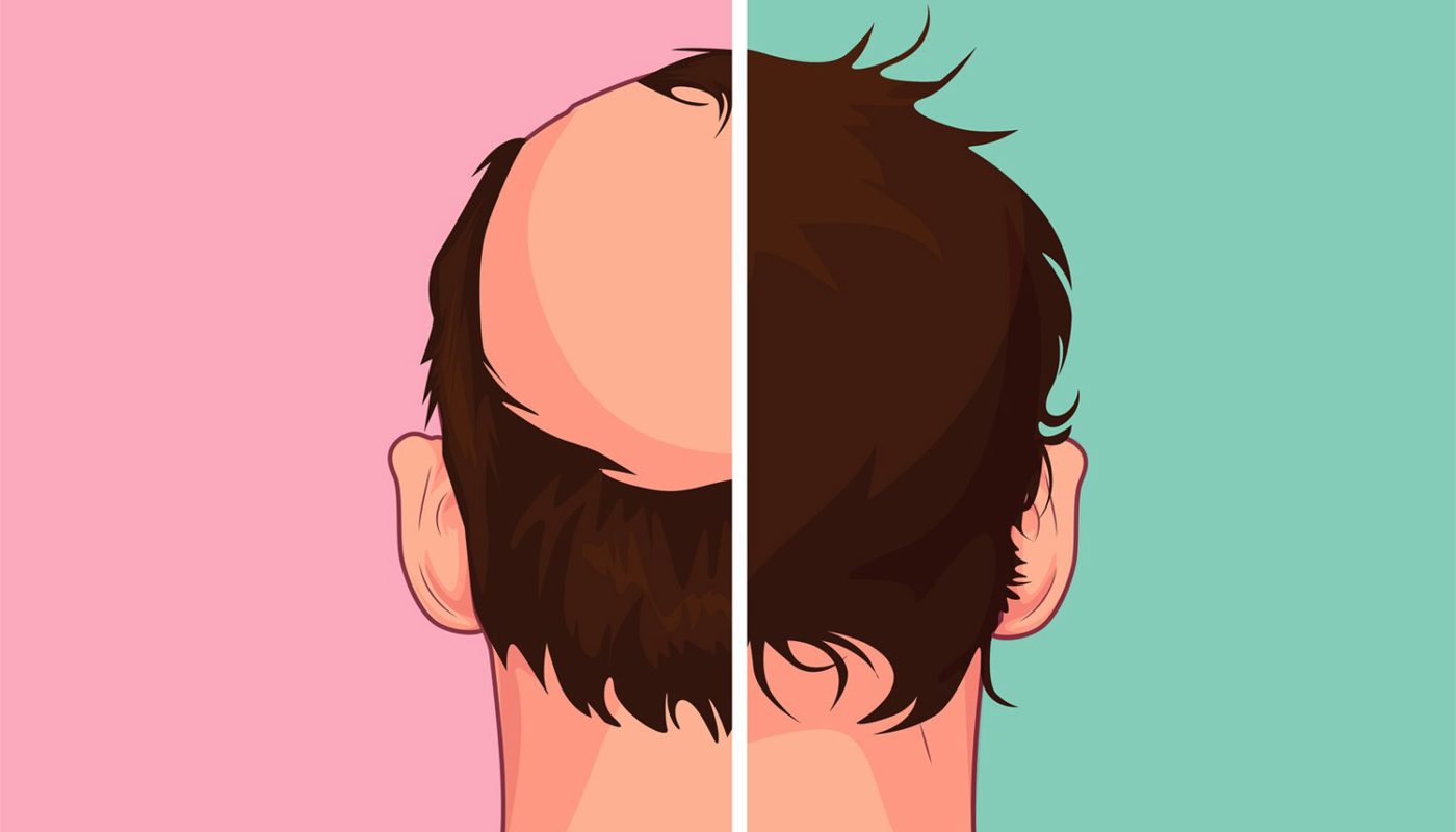 Quel pays choisir pour une greffe de cheveux